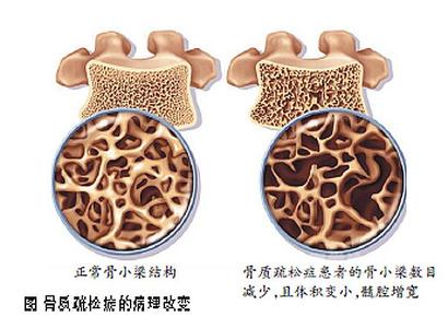正常與骨質(zhì)健康問(wèn)題骨密度對(duì)比